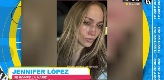 La cantante da un mal paso y al caer se fracturó la nariz