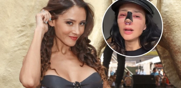 Dorismar revela mala praxis tras someterse a cirugía estética