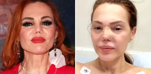 Carmen Campuzano se somete a nueva cirugía de nariz