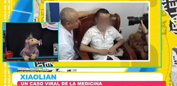 Un chico de 22 años es injertado en su frente una nueva nariz debido a un fuerte accidente en auto