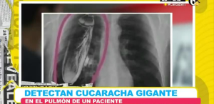 Detectan cucaracha gigante en pulmon de paciente