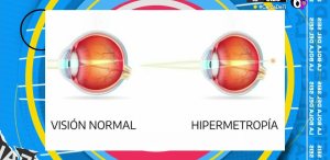 Conoce los diferentes padecimientos de la vista y sus diferencias