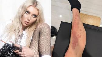 Taylor Momsen es hospitalizada por picadura de araña en México