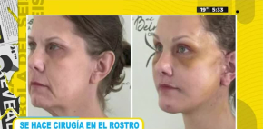 Se hace cirugía en el rostro y queda irreconocible