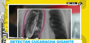 Detectan cucaracha gigante en pulmon de paciente