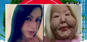 Influencer inicia reconstrucción facial tras vivir con el rostro desfigurado