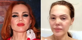 Carmen Campuzano se somete a nueva cirugía de nariz