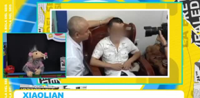 Injertan nariz en su frente por este raro motivo