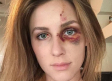 Así quedó el rostro de una joven golpeada por un campeón de motocross