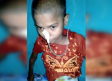 Médicos en la India extrajeron bola de pelo de 1.5 kilos del estómago de una niña
