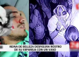 Modelo desfigura rostro de su ex pareja al estrellarle un vaso de vidrio