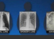 Cirujana muestra que los pulmones de pacientes con covid-19 lucen peor que los de fumadores