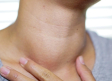 Dos de tres personas padecen de la tiroides y no tiene conocimiento; estos son los síntomas