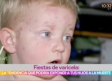 Fiestas de varicela: la tendencia que pone en riesgo la salud de tu hijo