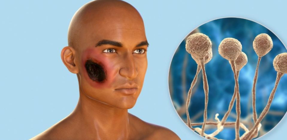“Hongo negro”: Advierten a estar atentos a la coinfección fúngica en Covid grave